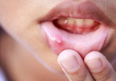 آفتین ژل: درمان سریع و مؤثر آفت‌ دهانی