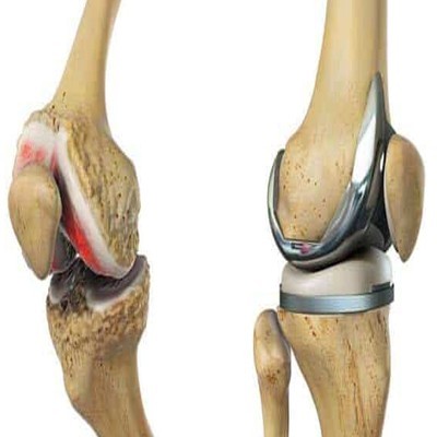 مصرف مکمل های غضروف ساز تا چه حدی می توانند موثر باشند