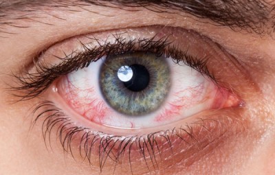 درمان خشکی چشم و راه های پیشگیری از  آن