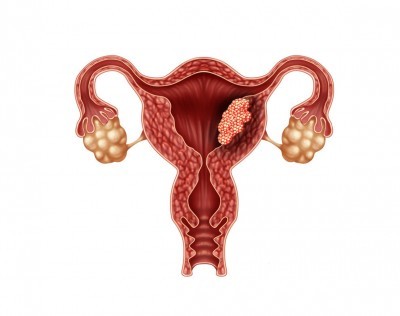 عوارض برداشتن پولیپ رحم