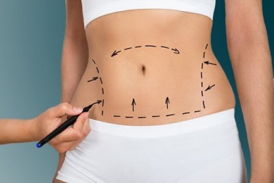 لیپوساکشن چگونه انجام می شود