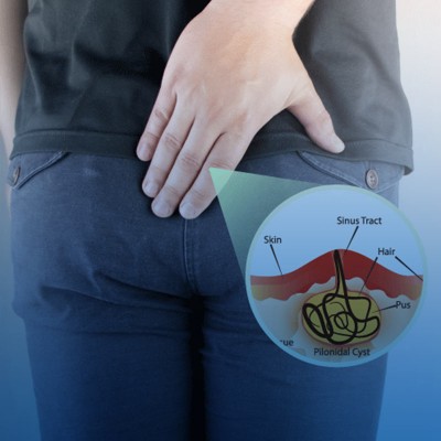 کیست مویی چیست و راه های درمان آن