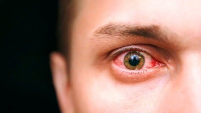 سکته چشمی چه علائمی دارد. بررسی علت آن