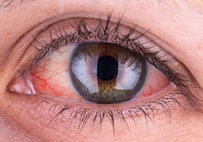 سندروم شوگرن و ارتباط آن با بیماری های چشمی؛ مهم‌ترین علائم، عوارض و روش‌های درمان