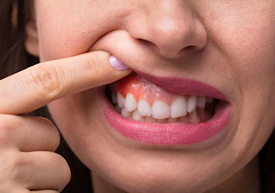آگونیست GLP-1 چه تاثیری بر سلامت دندان و لثه دارد؟